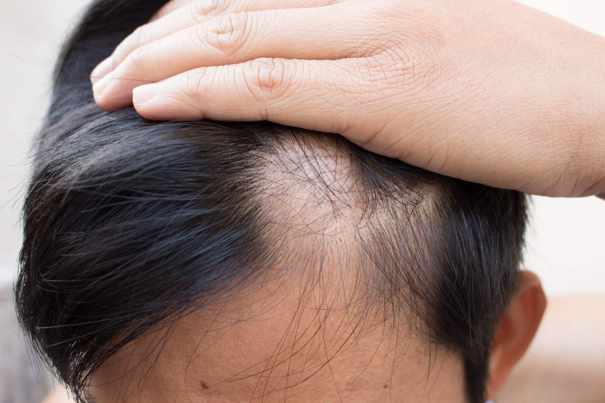 Types Of Alopecia Areata Alopecia Areata Hair Loss Treatment Srs